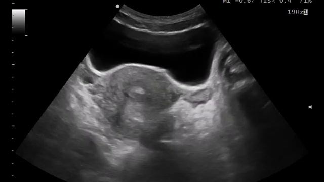 Case 115 : Hemorrhagic ovarian cysts смотреть онлайн