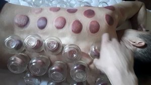 банки на спину, giác hơi