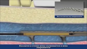Радиочастотная абляция вен при варикозе. РЧА на ногах