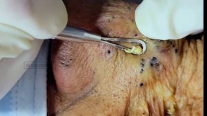 Massive blackhead removal inside a dermatology clinic | @Dr.AMAZINGSKIN
