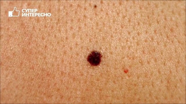 ЧЕМ ОПАСНЫ РОДИНКИ НА ТЕЛЕ? Можно ли удалять родинки? смотреть онлайн