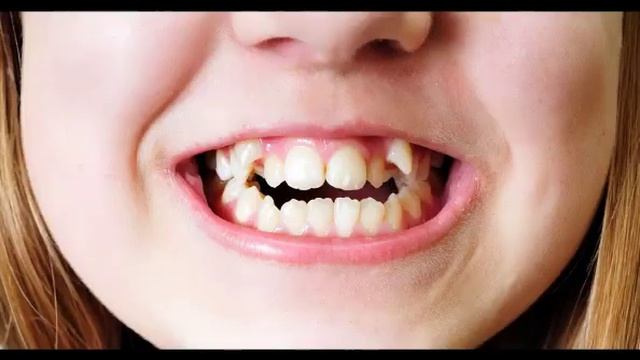 Как отучить ребенка от сосания пальца