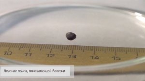 Камни в почках Лечение Ундоры. Отзыв