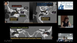 Височная кость: компьютерная томография. Семинар. Часть I. Людмила Кураева