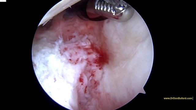 Shoulder Arthroscopy followed by Sub pectoral biceps tenodesis 7182016 MS смотреть онлайн