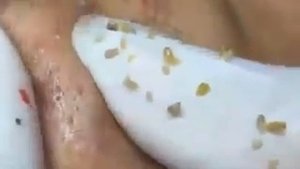 Extracion de espinillas y barros