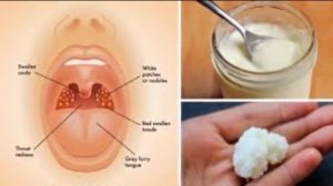 3 Powerful Home Remedies for Tonsillitis That Work Fast - Natural health cures