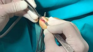Exostosis subungueal/Подногтевой экзостоз