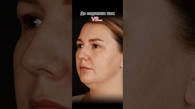 #DeepNeckLift —самая современная методика пластической хирургии в области шеи