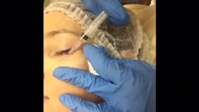 Биоревитализация зоны глаз смотреть онлайн