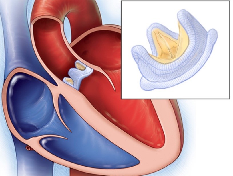 Митральный клапан после операции. Механический аортальный клапан сердца. Искусственный митральный клапан сердца. Протез митрального клапана. Механический протез аортального клапана.