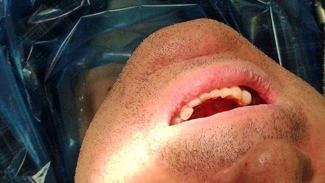 Установка культевой вкладки и метало керамической коронки. смотреть онлайн