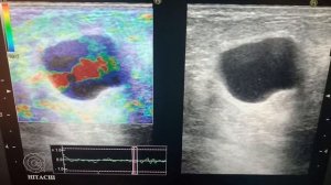 УЗИ Киста молочной железы. Соноэластография. Cyst of breast. Elastography.