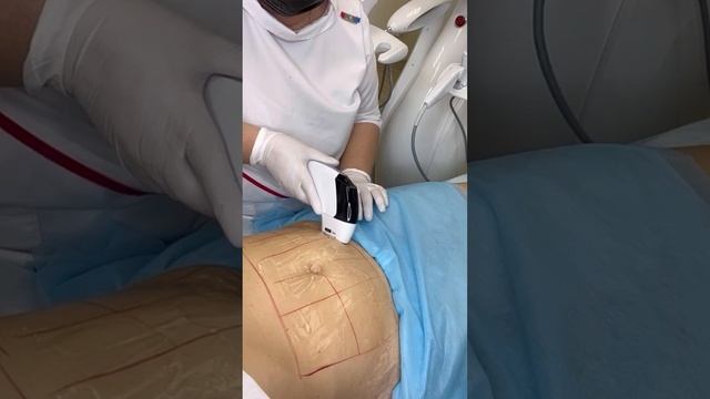 УЛЬТРАФОРМЕР - устранение локальных жировых отложений
