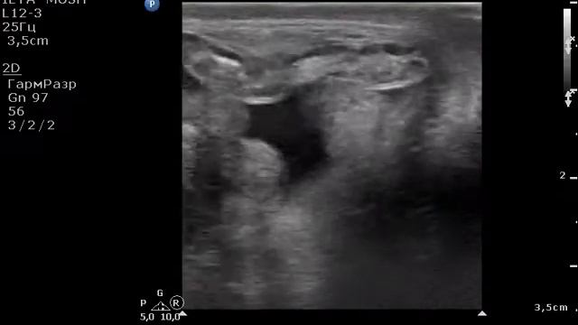 аппендикс в пахововй грыже №2 смотреть онлайн