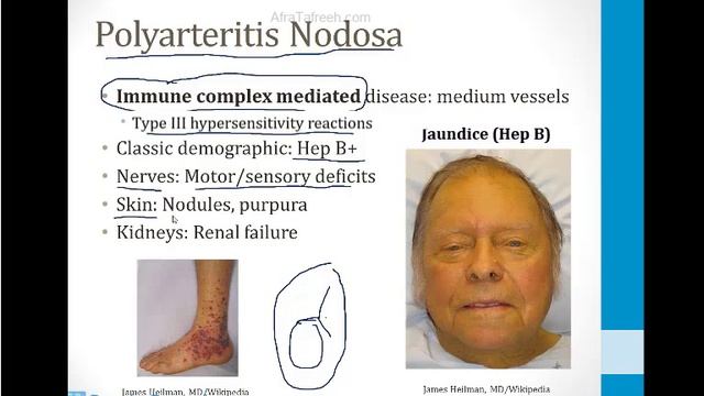 Иммунология USMLE - 4. Аутоиммунные расстройства - 5.Васкулит