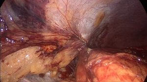 Laparoscopic Partial nephrectomy, Full time video _ Лапароскопическая резекция п.mp4