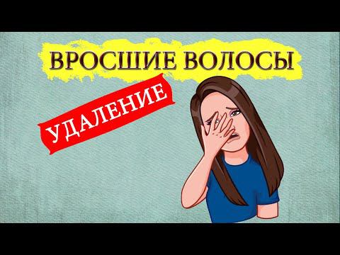 Вросшие волосы. Что делать и как удалить! смотреть онлайн