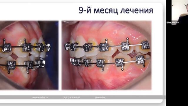 Детское ортодонтическое лечение несъемной аппаратурой смотреть онлайн