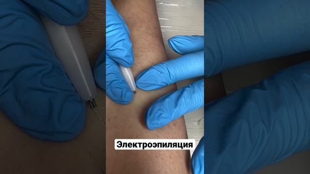 Электроэпиляция - удаляем волосы навсегда .