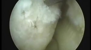 Субхондральная туннелизация