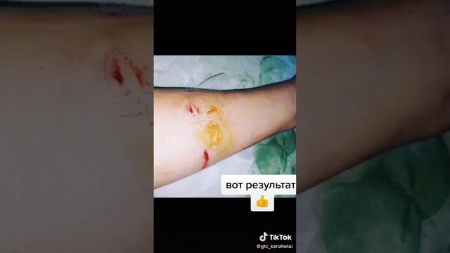 #укус собаки, #шрамы быстрое заживление 87078892018 смотреть онлайн