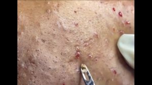 Remoção de cravo 2021 - Pimple Popping 2021 -Blackhead Removal  EP0022