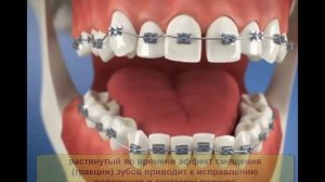 Брекеты: установка, плюсы и минусы разных брекет-систем, зубы до и после, цены, уход, снятие