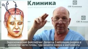 Подтяжка лица после нитевого лифтинга – Центр пластической хирургии СМ-Клиника