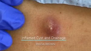 Enilsa's Top 5 Best Cyst Popping Compilation