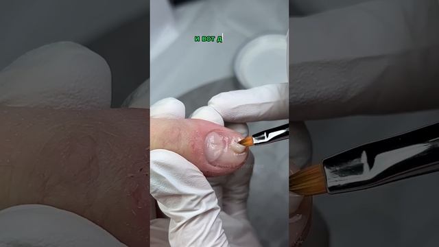 Ковыряет себе ногти / Самодеструкуция / Что с ногтями? Ковыряет ногти что делать?