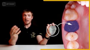Пересадка зуба мудрости на место разрушенного // Ortodony