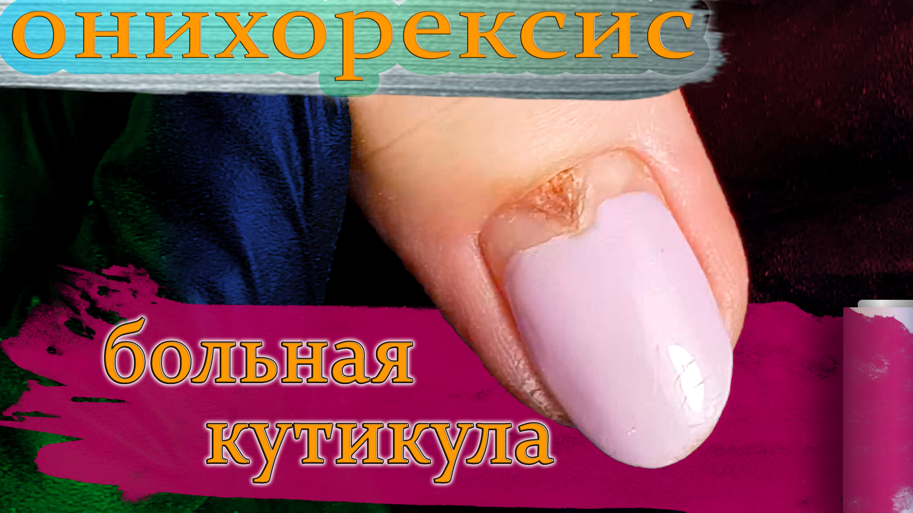 Онихорексис от кутикулы