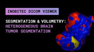 Сегментация и 3D-представление: гетерогенные опухоли мозга
