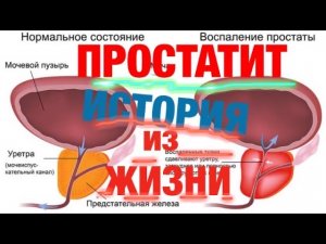 Простатит - реальная история, часть 1