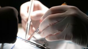 Клинический случай: Удаление бляшки из сонной артерии. Не допустить третий инфаркт!