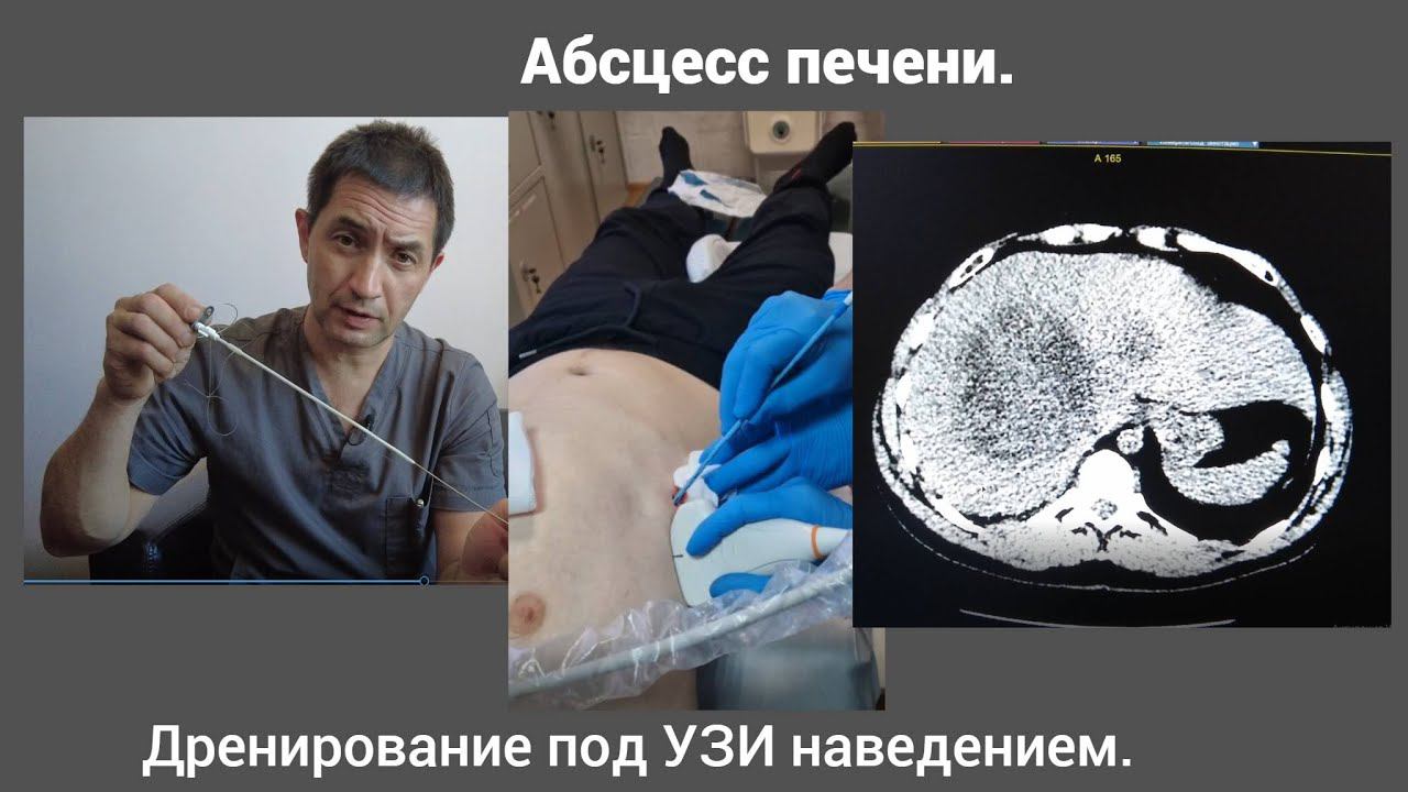 Абсцесс печени. Дренирование под УЗИ наведением.