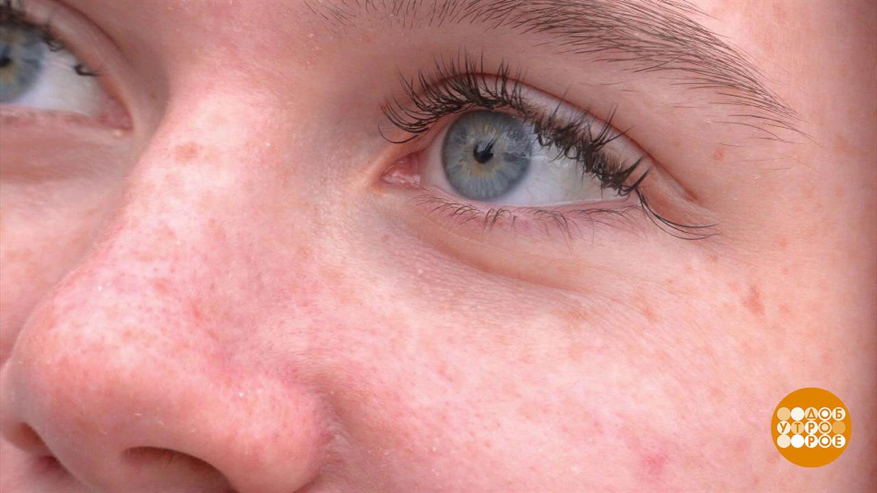 Веснушки: во-первых, это красиво... Доброе утро. Суббота. Фрагмент выпуска от 13.04.2024