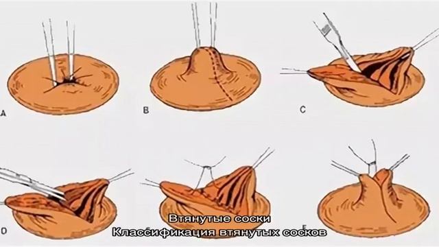 Как должны выглядеть соски Втянутые соски - смотреть видео онлайн от "Metal Marvels" в хорошем качестве и б