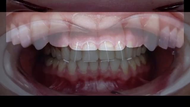 Керамические виниры смотреть онлайн