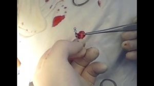 Остеосинтез скуловой кости 1 точечная фиксация