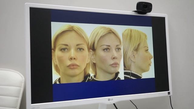 Как костная пластика влияет на черты лица. Контурная пластика. Костная пластика. Пластика подбородк