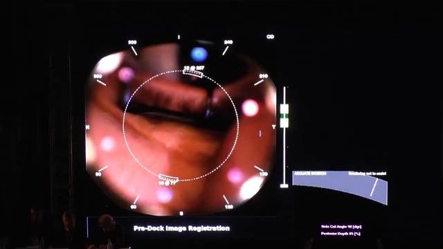 Фемтолазерная коррекция сложного гиперметропического астигматизма