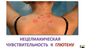 Всем ли надо отказываться от глютена