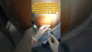THORACENTESIS / ПЛЕВРАЛЬНАЯ ПУНКЦИЯ