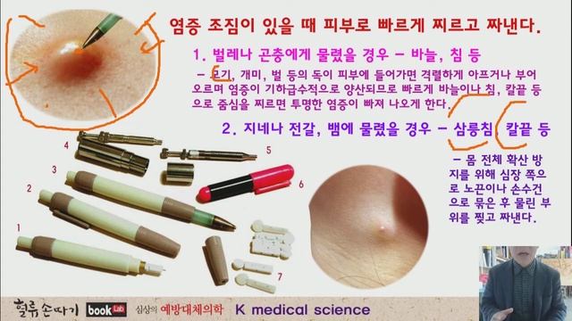 염증치료 37강. 동상 치료와 염증 제거의 실제. 염증은 인체의 쓰레기장. Treatment of inflammation and frostbite. смотреть онлайн