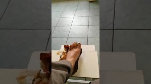 Перевязка после удаления ногтя.