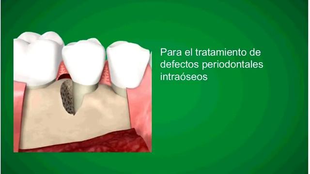 011 Emdogain Straumann Regenerative System смотреть онлайн