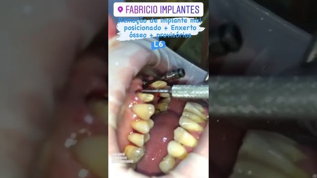REMOÇÃO DE IMPLANTE MAL POSICIONADO + ENXERTO ÓSSEO + PROVISÓRIO - FABRICIO IMPLANTES - ARUJÁ - SP смотреть онлайн