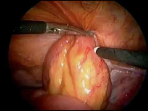 ущемленная паховая грыжа incarcerated inguinal hernia Abolmasov A смотреть онлайн